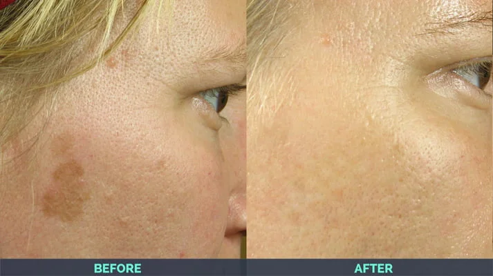 age spots removed after IPL laser skin treatment