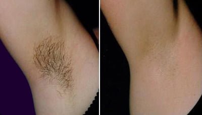 womans underarm with hair removed before and after shot asheville nc
