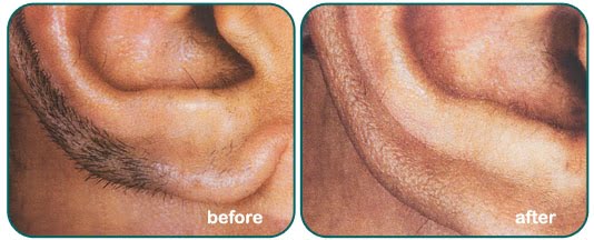 man showing before and after from laser hair removal in asheville
