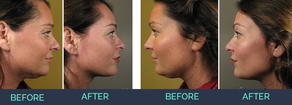 kybella before and after photos