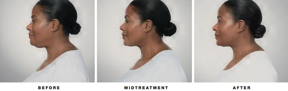 kybella before and after