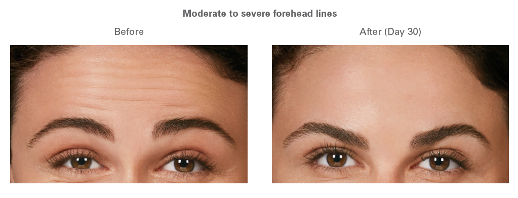 How do I ask for a Botox touch up? - Mountain Radiance Medical Spa