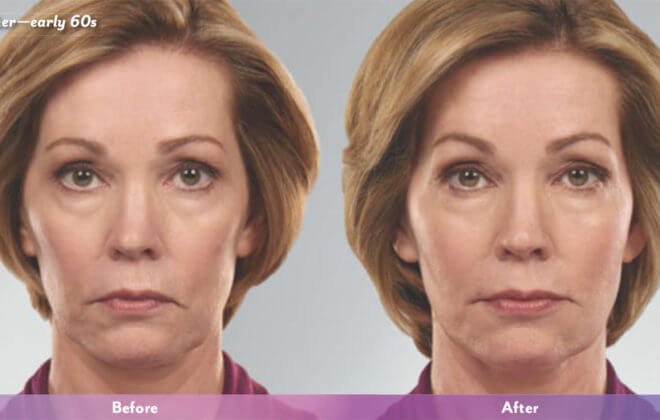 Juvederm dermal filler results