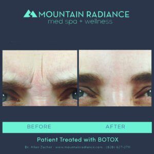 botox mountain radiance before and after