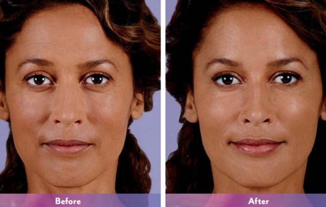 Juvederm dermal filler results