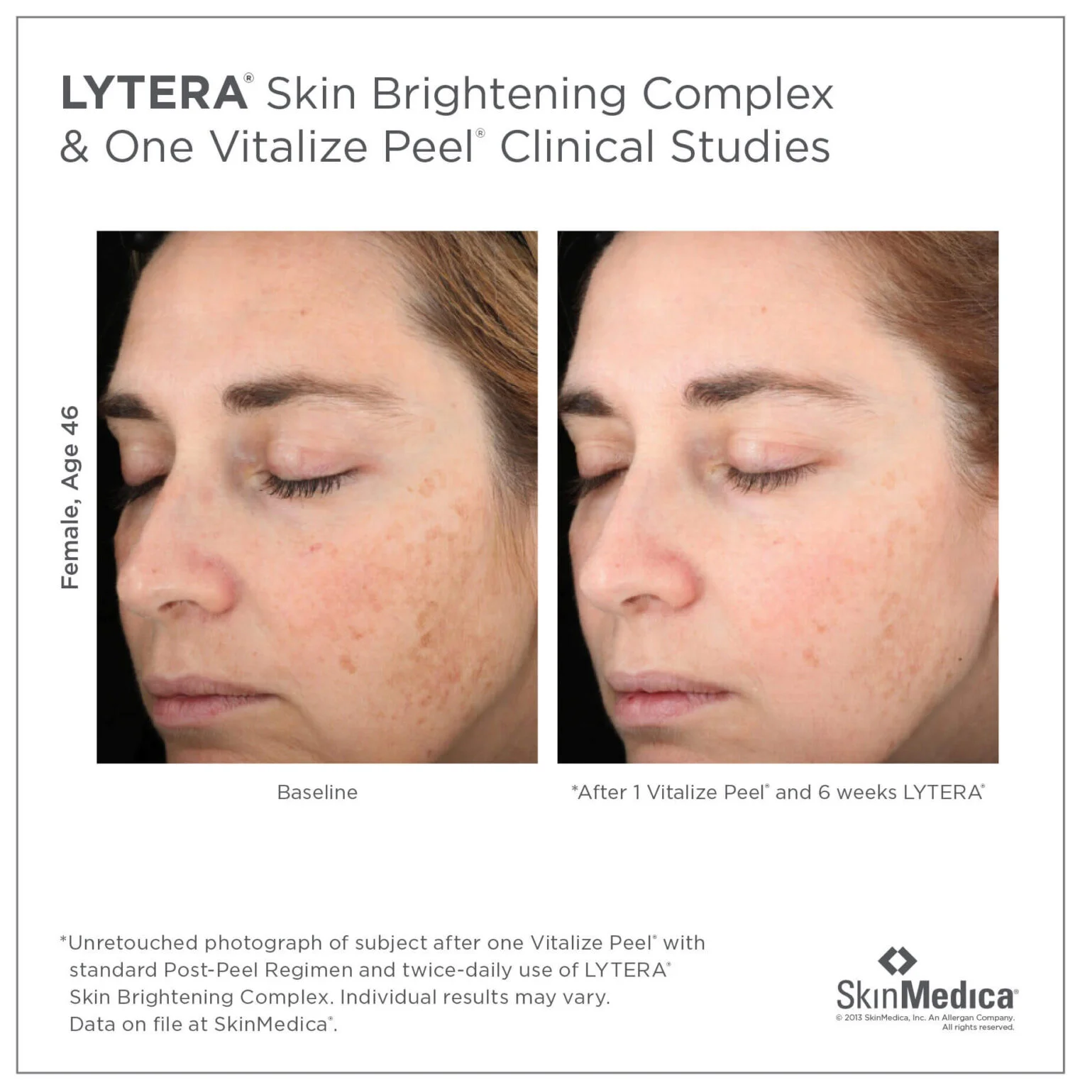 Patient shown before and after Lytera Skin Brightening Comple and Vitalize Peel