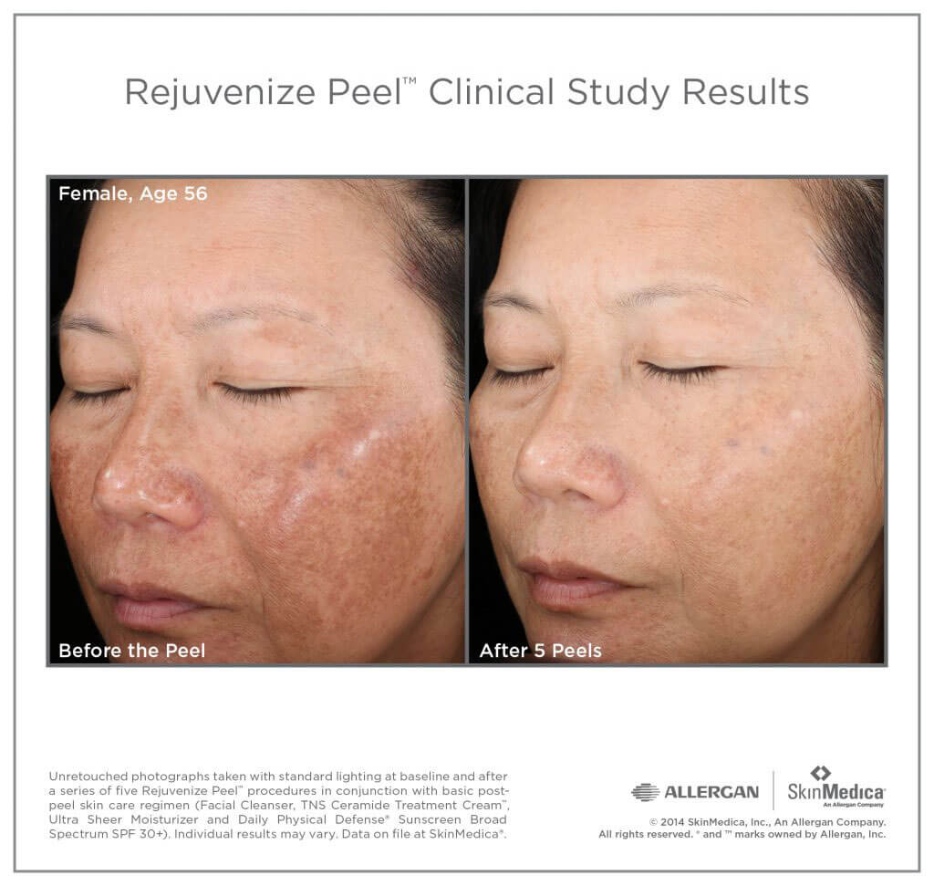 Woman shown before and after Skinmedica chemical peel