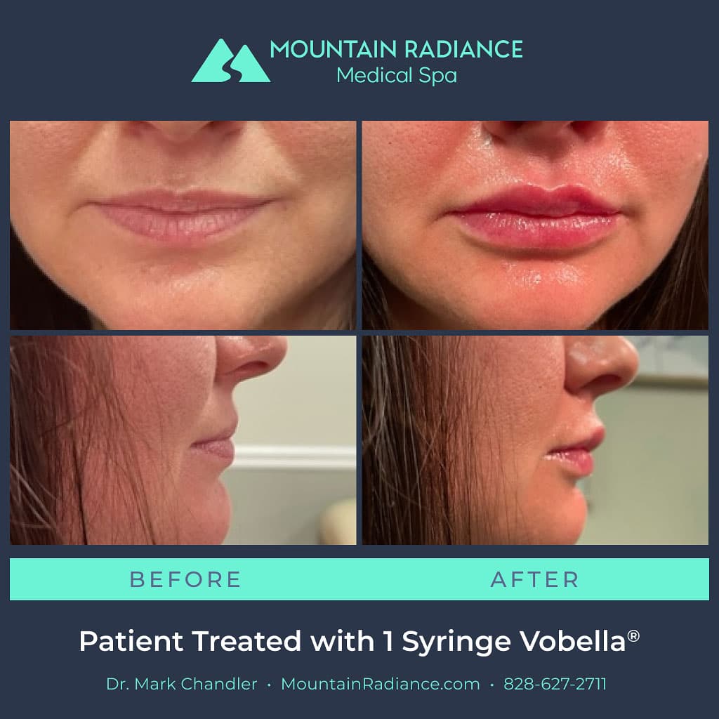 Before and after image of Volbella Lip Filler patient
