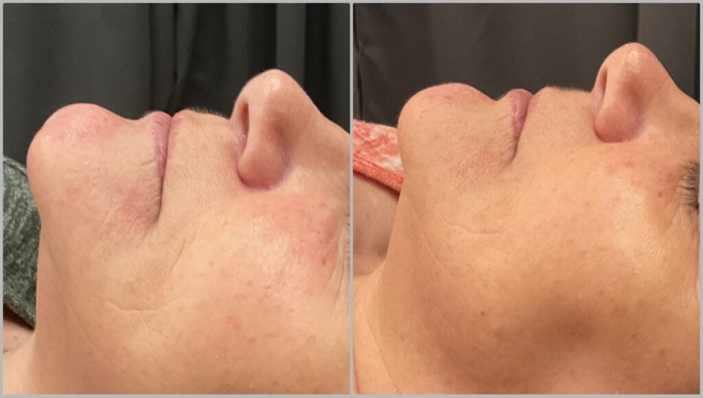 ProCell Microchanneling before and after