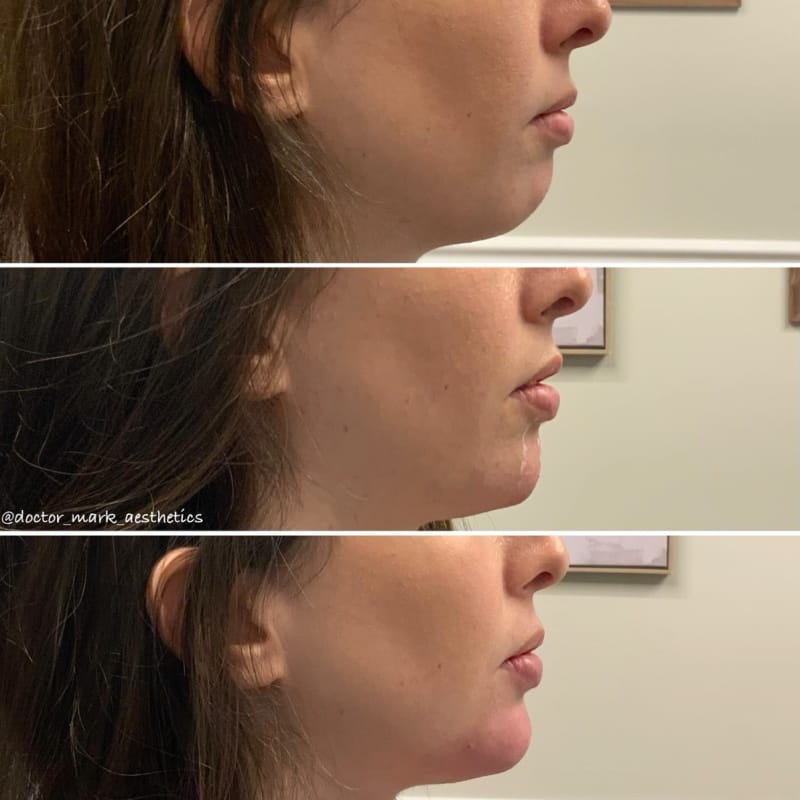 Before and after chin filler for jawline contouring with Juvederm at Mountain Radiance medical spa in Asheville, NC