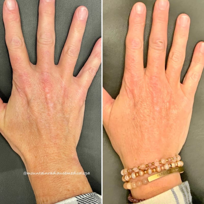 Before and after CO2 laser resurfacing and filler for hand rejuvenation