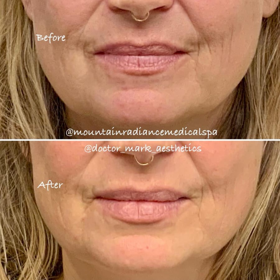 Patient shown before and after Restylane fillers at Mountain Radiance med spa in Asheville