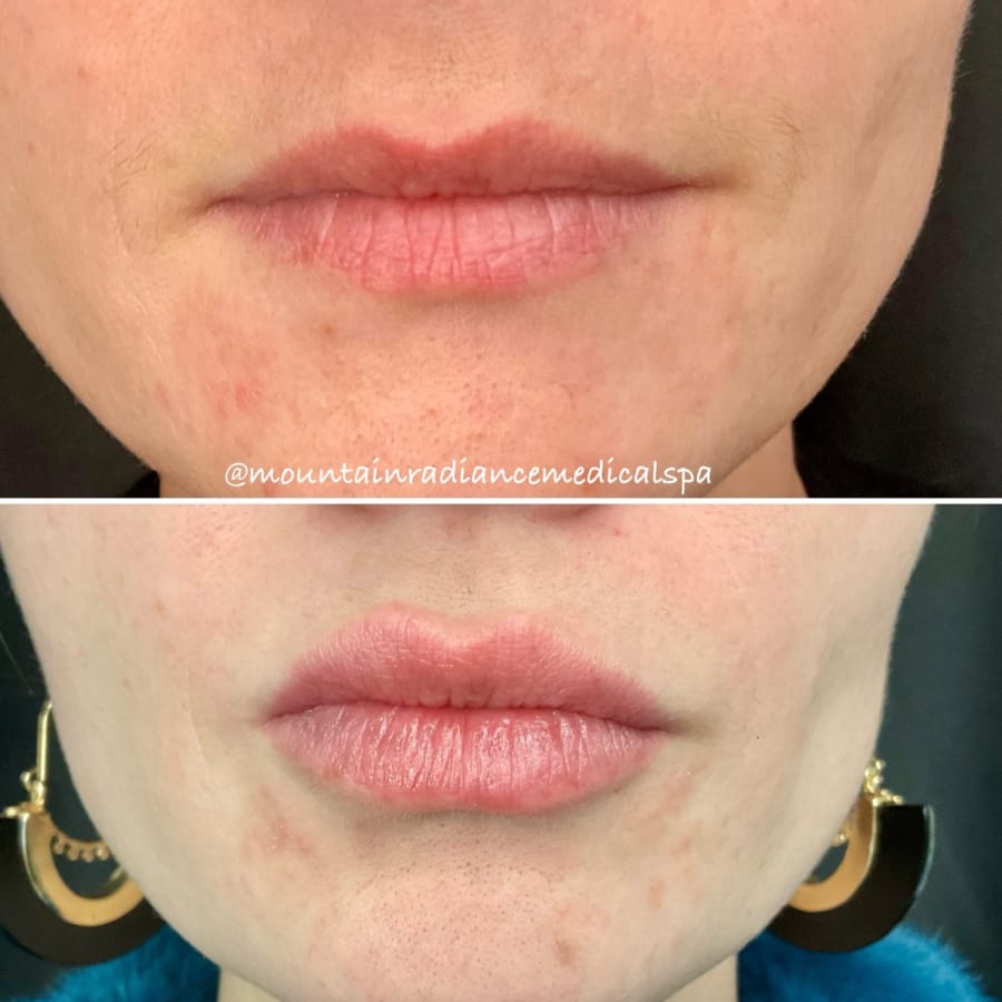 Before and after lip filler at Mountain Radiance med spa in Asheville