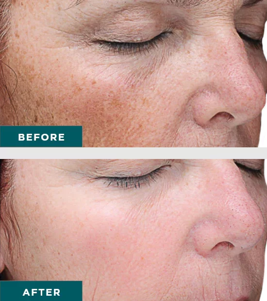 Patient shown before and after VI Peel Precision Plus