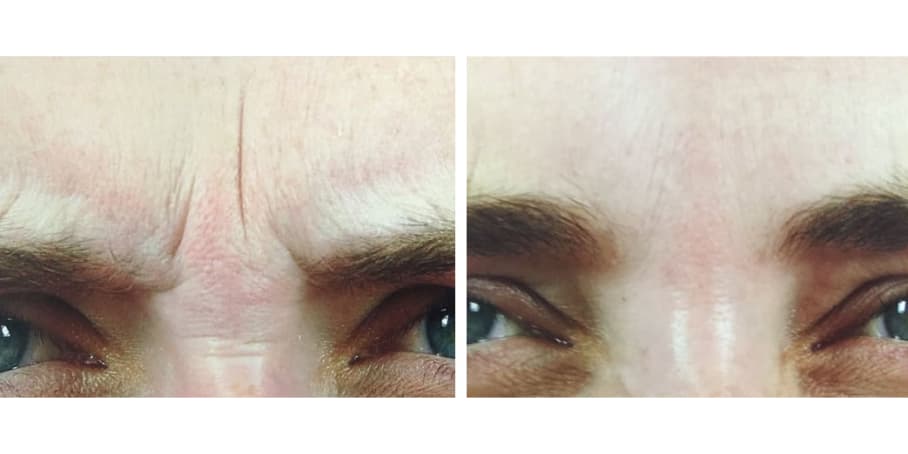 Before and after image of patient treated with Botox