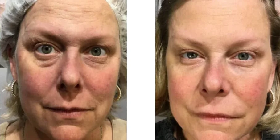 Before and after image of patient treated with Botox and Filler for a Full Facial Rejuvenation
