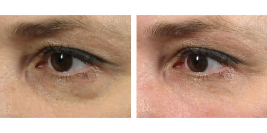 Before and after image of patient treated with filler to treat Hollow Eyes