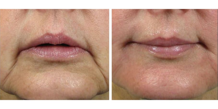 Before and after image of patient treated with filler to reduce marionette lines