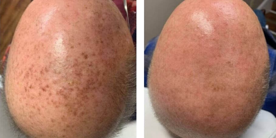 Before and after image of patient treated with IPL to reduce age spots on top of head