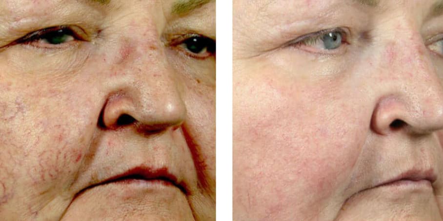Before and after image of patient treated with IPL to reduce veins