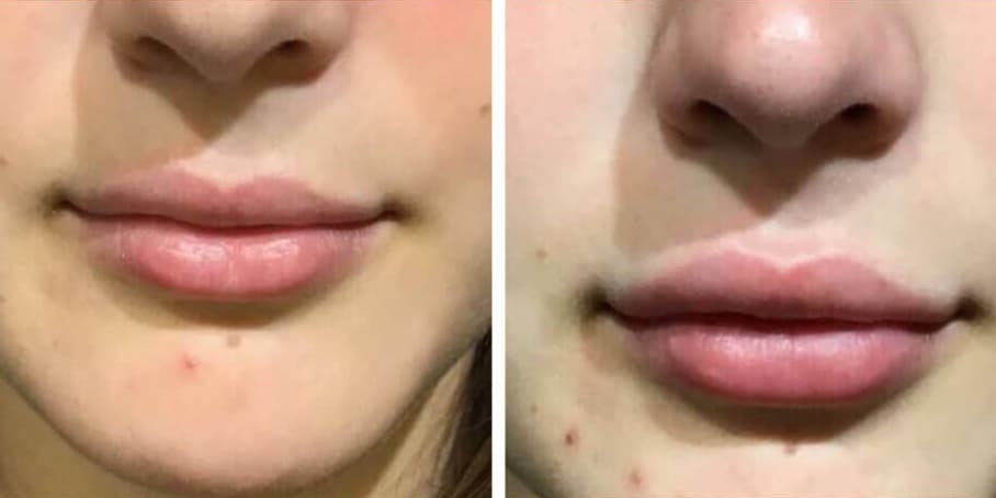 Before and after image of patient treated with lip filler to enhance lips