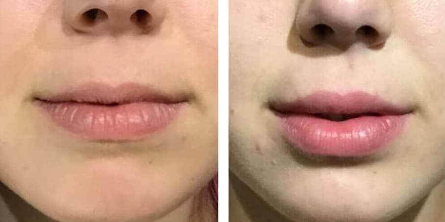 Before and after image of patient treated with lip filler to enhance lips