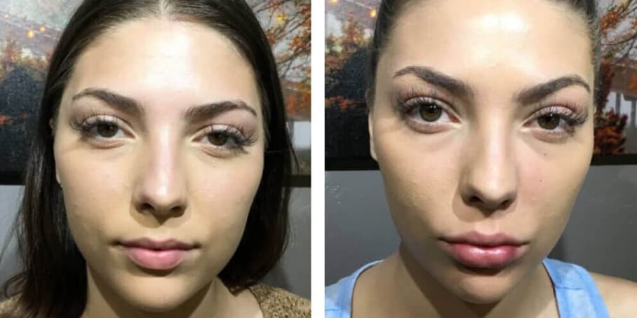 Before and after image of patient treated with a lip filler to enhance lips