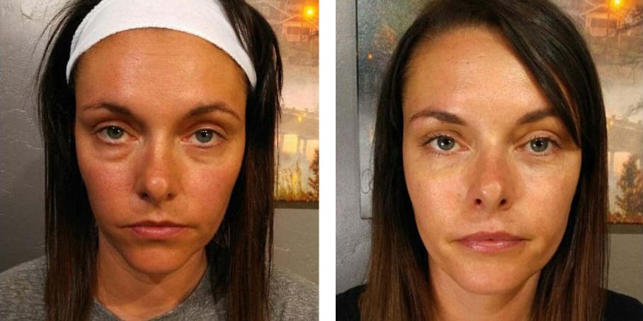 Before and after image of patient  treated with Under Eye Filler to reduce Hollow Eyes