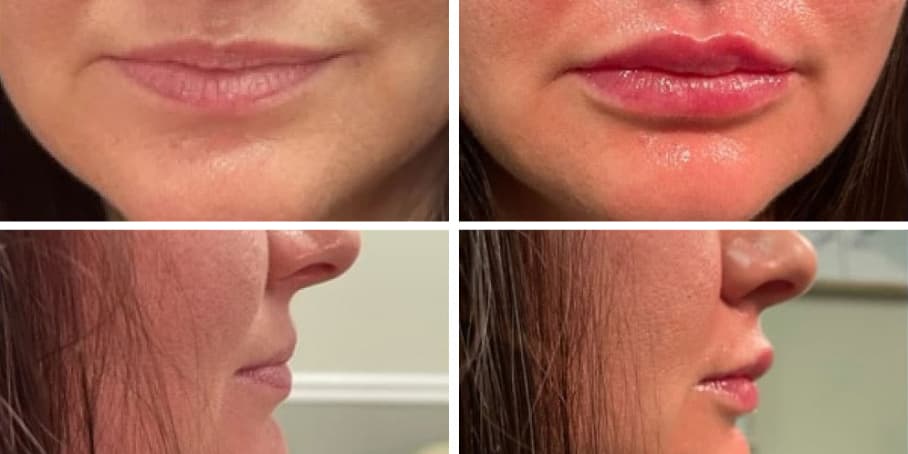 Before and after image of patient treated with Volbella to enhance lips