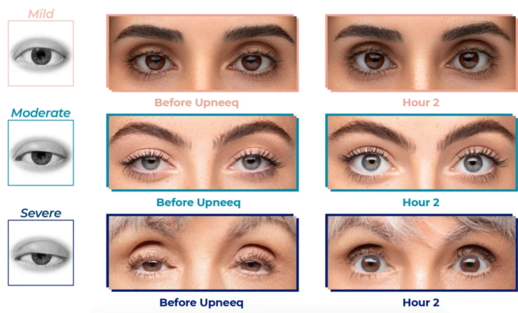 Real patients shown before and after using Upneeq eye drops for brighter eyes and eye-widening treatment 