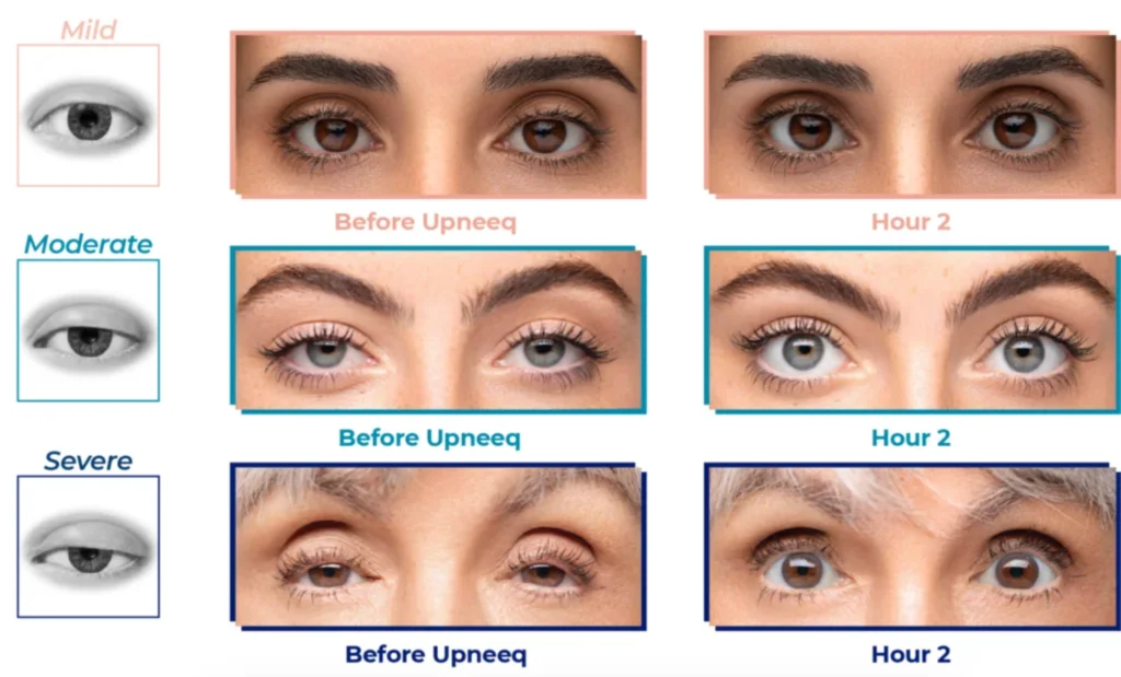 Real patients shown before and after using Upneeq eye drops for brighter eyes and eye-widening treatment