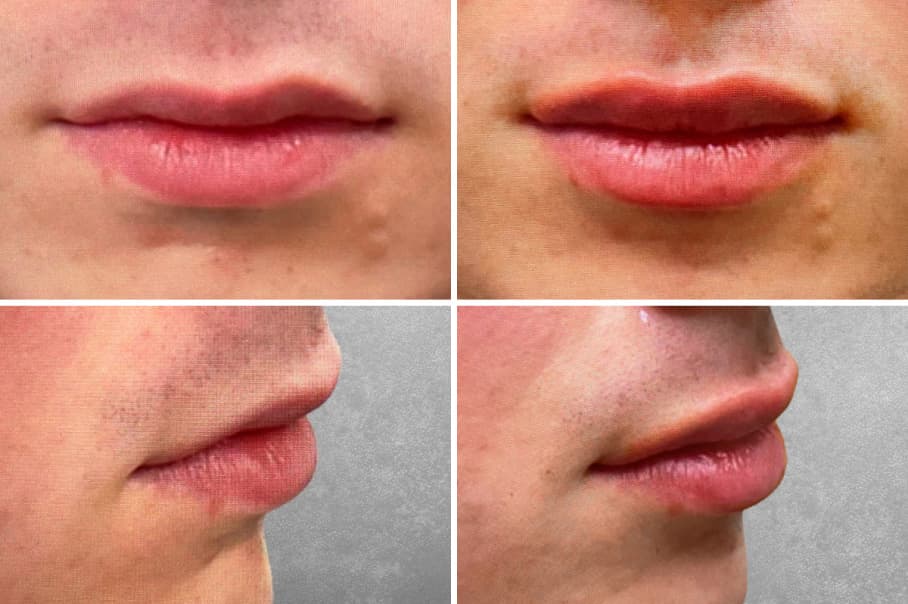 Before and After Mountain Radiance Lip Filler Patient Results