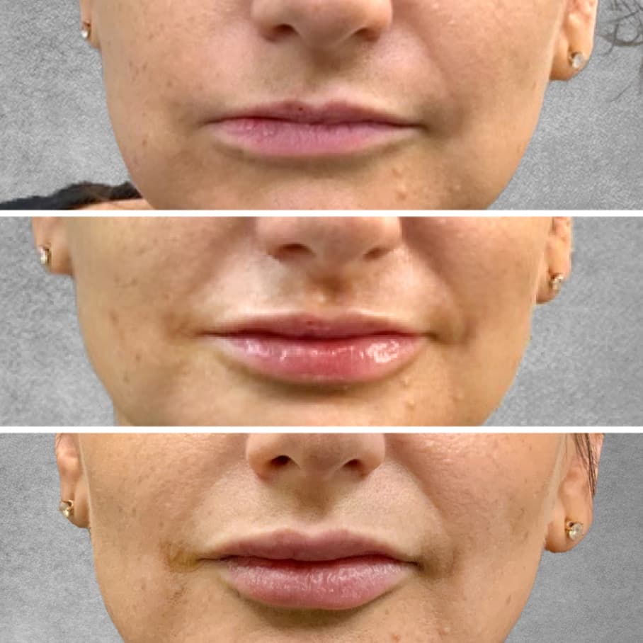Before and After Mountain Radiance Lip Filler Patient Results