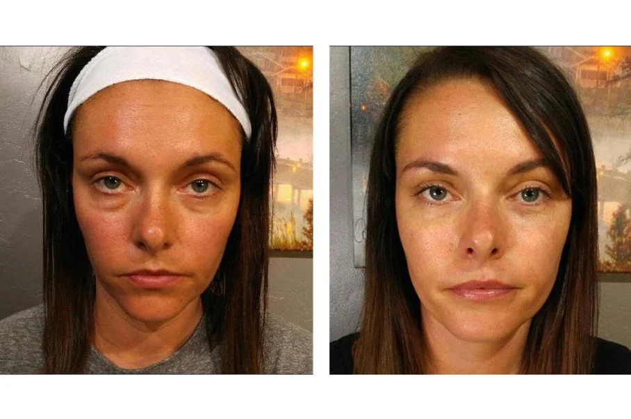 Before and after image of patient  treated with Under Eye Filler to reduce Hollow Eyes