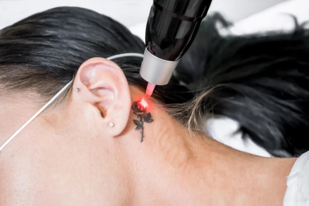 Laser tattoo removal at a medical spa
