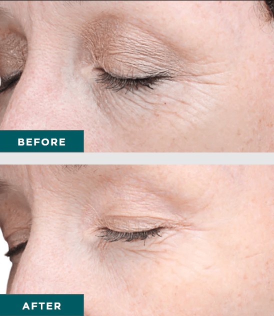 Patient shown before and after VI Peel Advanced