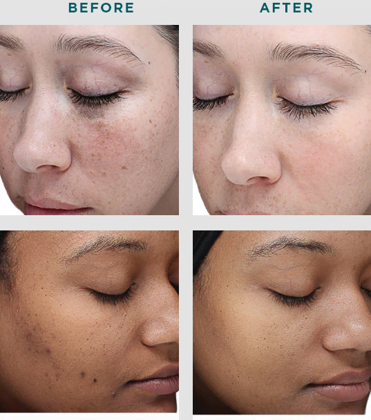 Patients shown before and after VI Peel Original