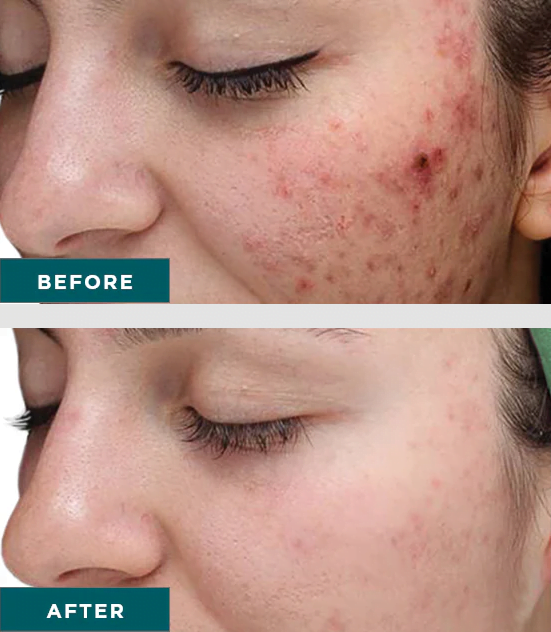Patient shown before and after VI Peel Purify with Precision Plus