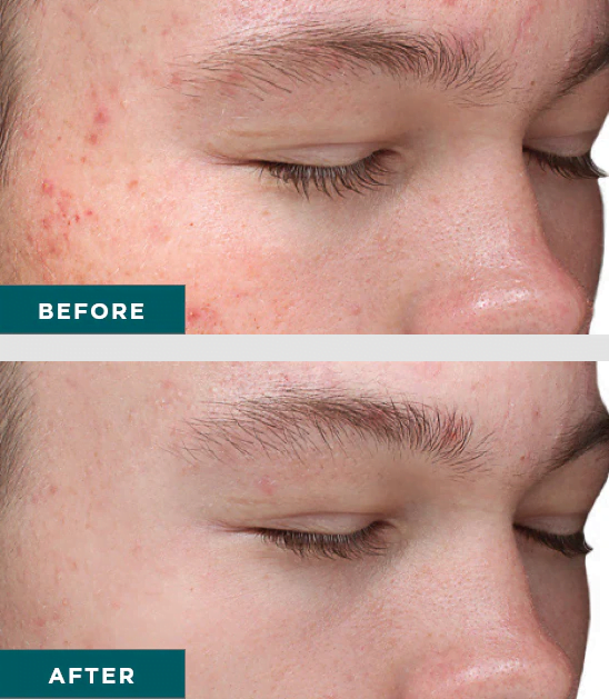 Patient shown before and after VI Peel Purify
