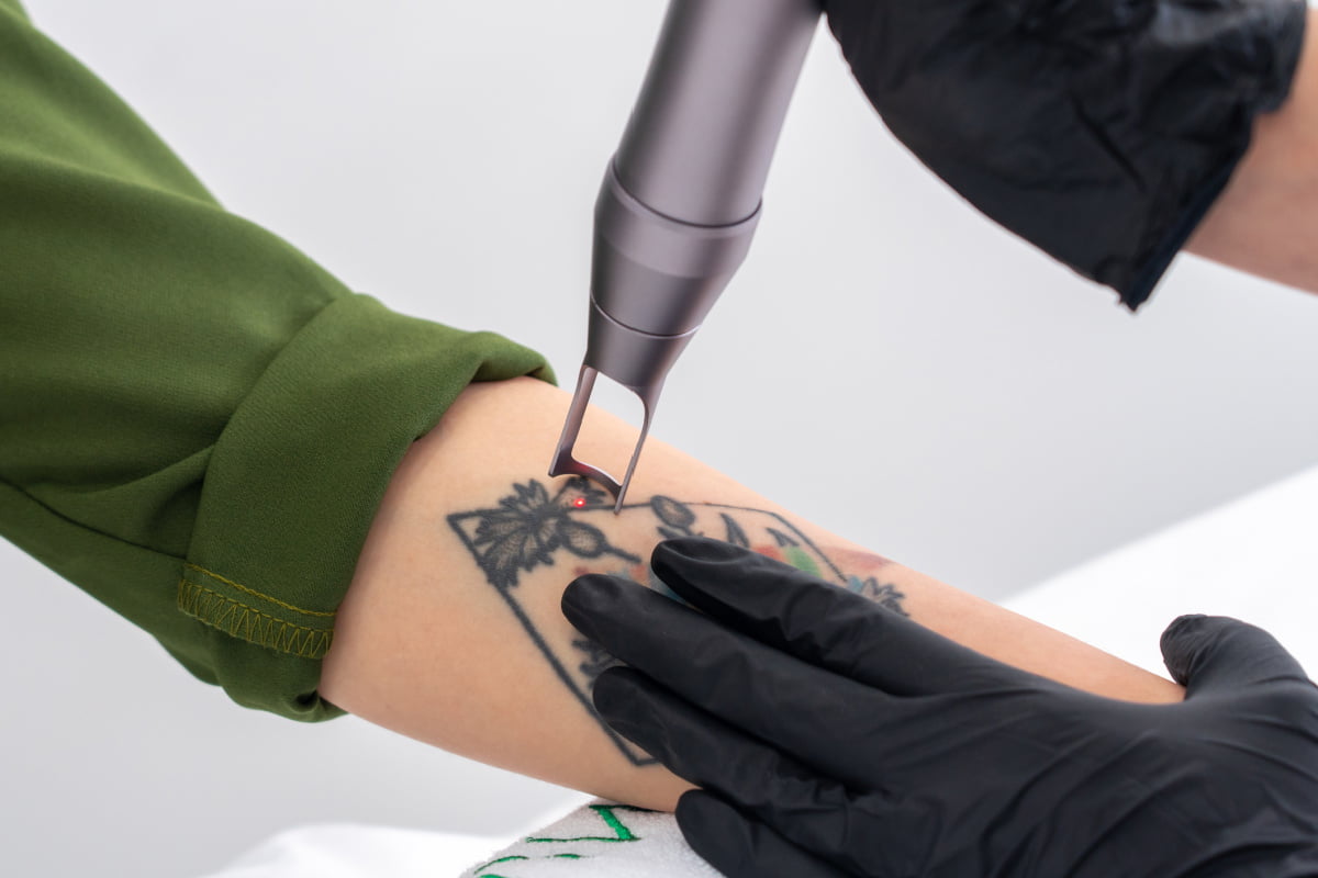 Woman getting her arm tattoo removed with a laser treatment at a medical spa