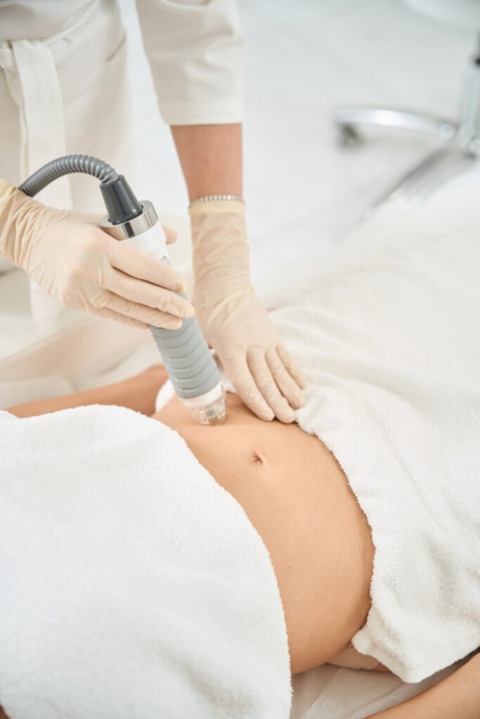 Women getting a radiofrequency microneedling treatment on her abdomen to treat stretch marks 