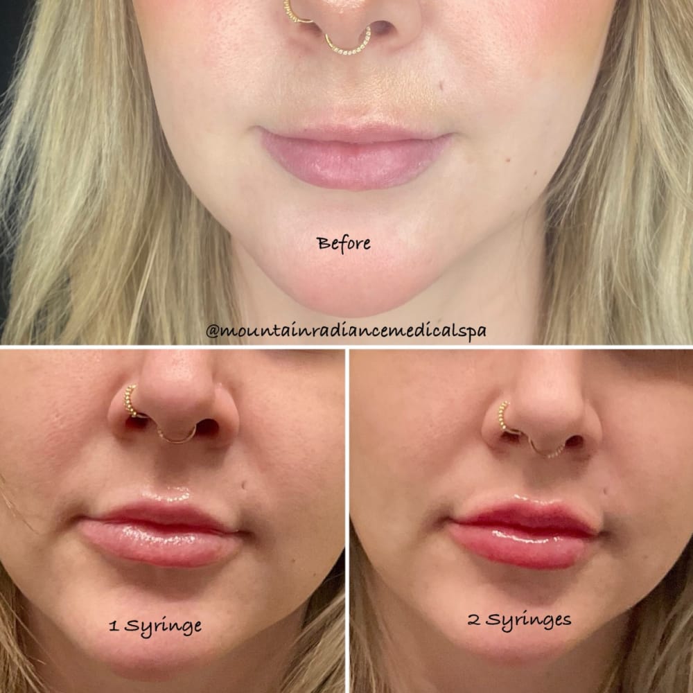 Before and after 1 and 2 syringes of lip fillers at Mountain Radiance medical spa in Asheville