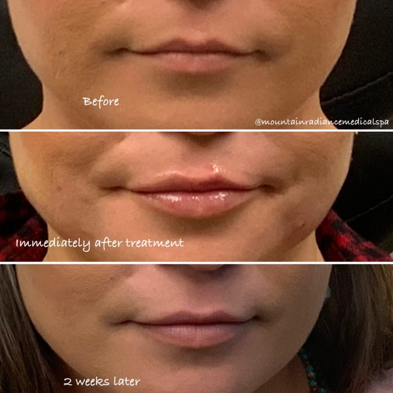 Patient shown before, immediately after, and 2 weeks after lip filler treatment at Mountain Radiance, an Asheville med spa
