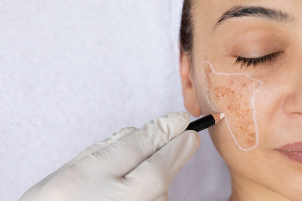 Woman with hyperpigmentation at a medical spa for skin treatments