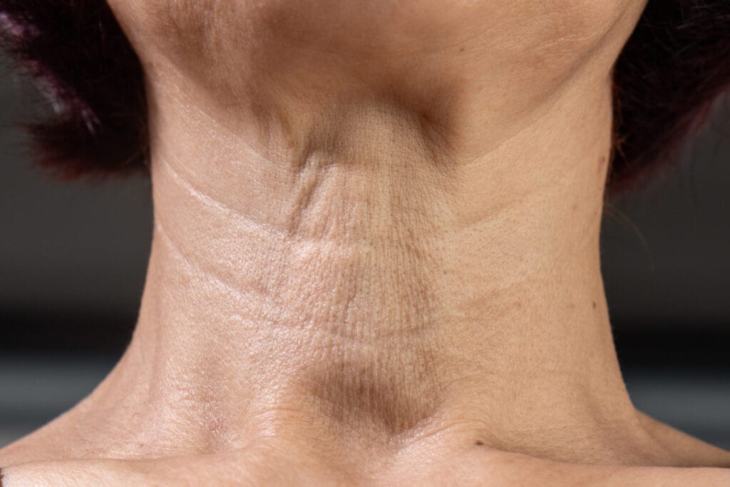 Close up of neck wrinkles and crepey neck skin